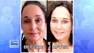 See Woman’s Incredible Before and After Facial Rejuvenation [upl. by Donegan414]