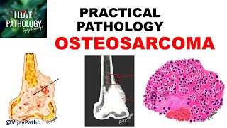 Osteosarcoma  Pathology Symptoms Diagnosis Treatment [upl. by Digirb154]