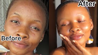 How I Truly Got Rid Of My Pimples In 2 Weeks  Clear Skin [upl. by Egiedan548]