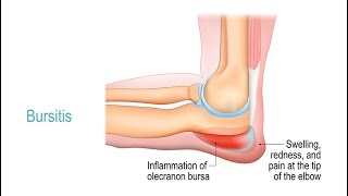 Treating Bursitis [upl. by Aylsworth612]