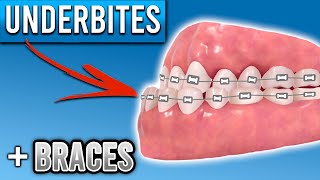 How Do Braces Fix Underbites  Premier Orthodontics [upl. by Hali]