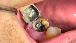 4 Wisdom Teeth Removal Surgery [upl. by Namia]