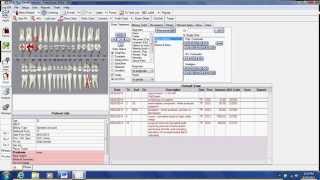 EZ 2000 Plus Dental Software  Treatment Planning [upl. by Nivlac]