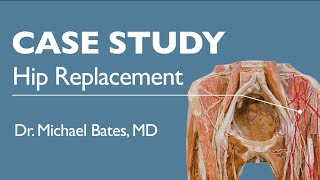 Hip Replacement Surgery Explained [upl. by Cohette]