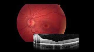 Retina Imaging amp ERG [upl. by Lindsey]