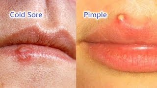 Pimple vs Cold Sore The Differences Identification and Treatment [upl. by Hatti]