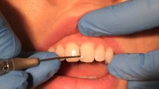 Periodontal Probing [upl. by Rhiana]