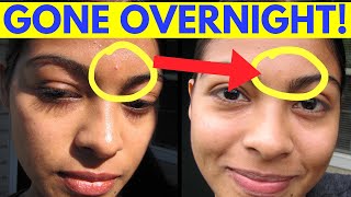 Reduce Pimple Inflammation Overnight [upl. by Preston]