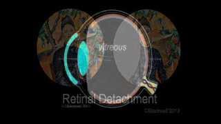 Retinal Detachment [upl. by Lesya]