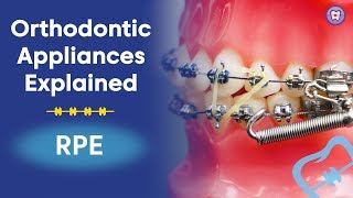 Orthodontic Appliances Explained  RPE [upl. by Avlasor]