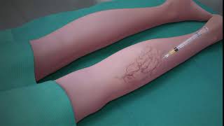 Sclerotherapy Procedure [upl. by Aihpled408]