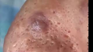 Pimples Popping On Nose Part 1 [upl. by Anirdua]