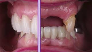 Before and After Partial Denture Replaced by a Zirconia Lingual with Ceramic Bridge Transformation [upl. by Honniball]