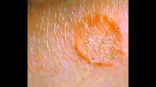 Skin Fungus Signs Symptoms Treatment HD [upl. by Damiano]