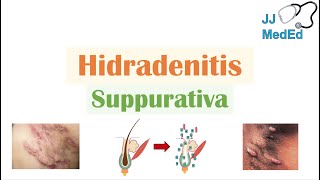 Hidradenitis Suppurativa HS  Pathophysiology Triggers Signs amp Symptoms Diagnosis Treatment [upl. by Cornie]