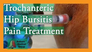 HipTrochanteric Bursitis Watch This [upl. by Etnauq]