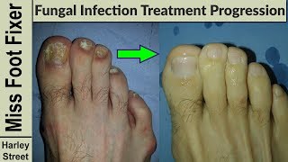 Nail Treatment Progression photo before and after by fungal nail expert [upl. by King740]