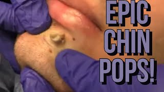 Chin Pimples And Zits  Facial Acne 2020  The BEST Chin Extractions [upl. by Laon]