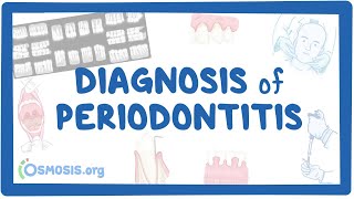 Diagnosis of Periodontitis [upl. by Eilsehc]