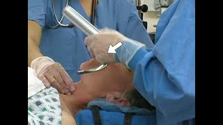 Orotracheal Intubation [upl. by Adnoral110]