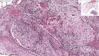 Osteosarcoma  Histopathology [upl. by Ahders]