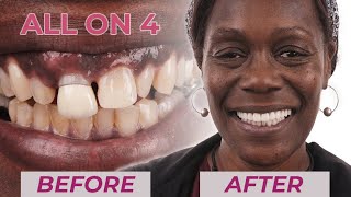 AllOnImplant Dental Implants Before amp After Missing Teeth Smile Transformations  Dental Boutique [upl. by Lew]