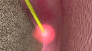 Laser Periodontal Therapy  WPT™ Animation [upl. by Rutherford395]