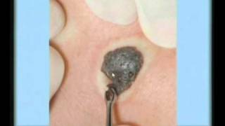 Seborrheic Keratosis Treatment [upl. by Chad]