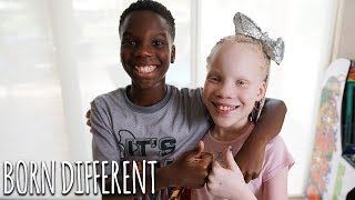 My Twin Sister Has Albinism  BORN DIFFERENT [upl. by Emmer]