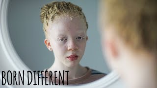 I’m Black Even With Albinism  BORN DIFFERENT [upl. by Faline]