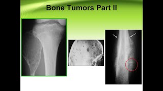 Ewing Sarcoma Femur [upl. by Leila]