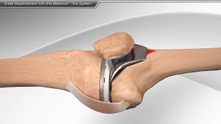 Knee Replacement with the iBalance TKA System [upl. by Anoyek]