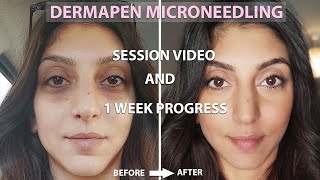 Dermapen Microneedling Before And After  Process  1 Week Amazing Results [upl. by Hairim429]