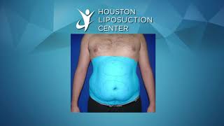 Liposuction for Men  Liposuction Before amp After [upl. by Enayr]