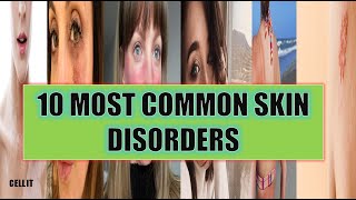 10 MOST COMMON SKIN DISORDERSDISEASES IN HUMANS [upl. by Kirch]