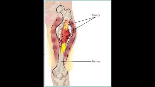 Ewings Sarcoma [upl. by Skyler]