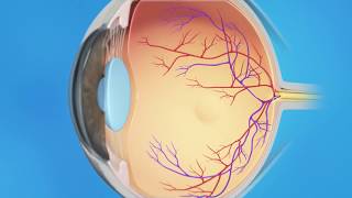 Macular Hole Vitrectomy Surgery [upl. by Ziegler]