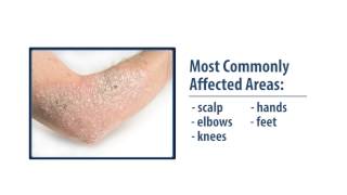 Common Skin Disorders Eczema amp Psoriasis [upl. by Ybab]