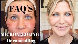 Microneedling  Dermarolling QampA  Before During and After Pics [upl. by Corrianne88]