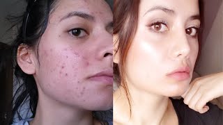 Tretinoin Before and After 12 Tips To Get The BEST RESULTS [upl. by Euf]