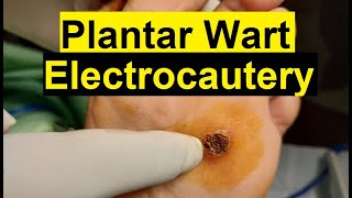 Treatment of Viral Warts  Electrocautery Procedure [upl. by Ailuj]